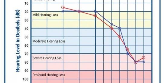 Hearing Level In Decibels Chart