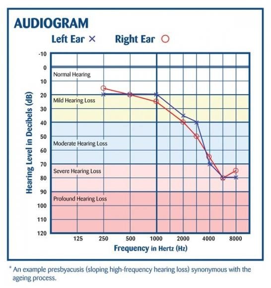 Audiogram